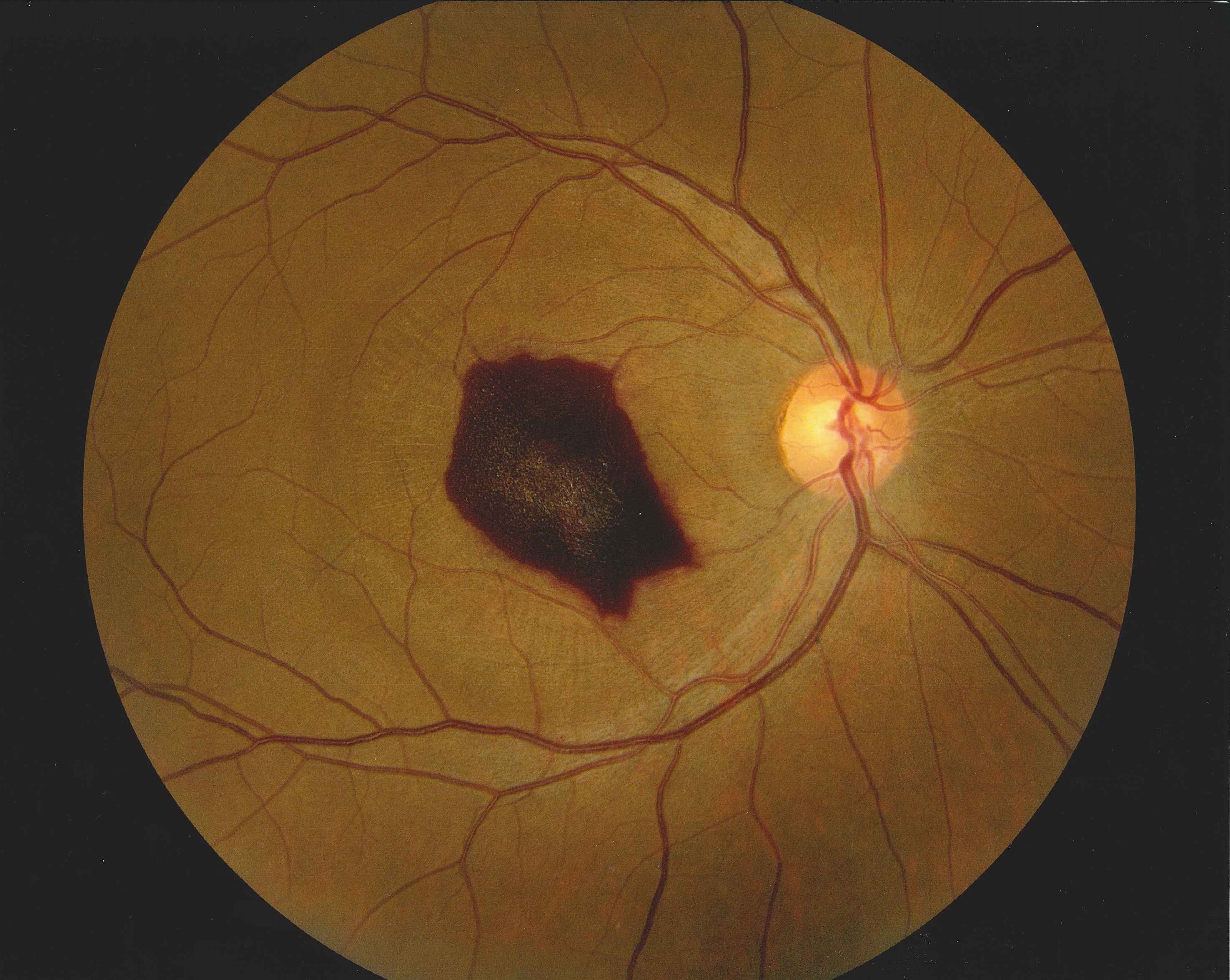 Retinal Hemorrhage | ASCRS