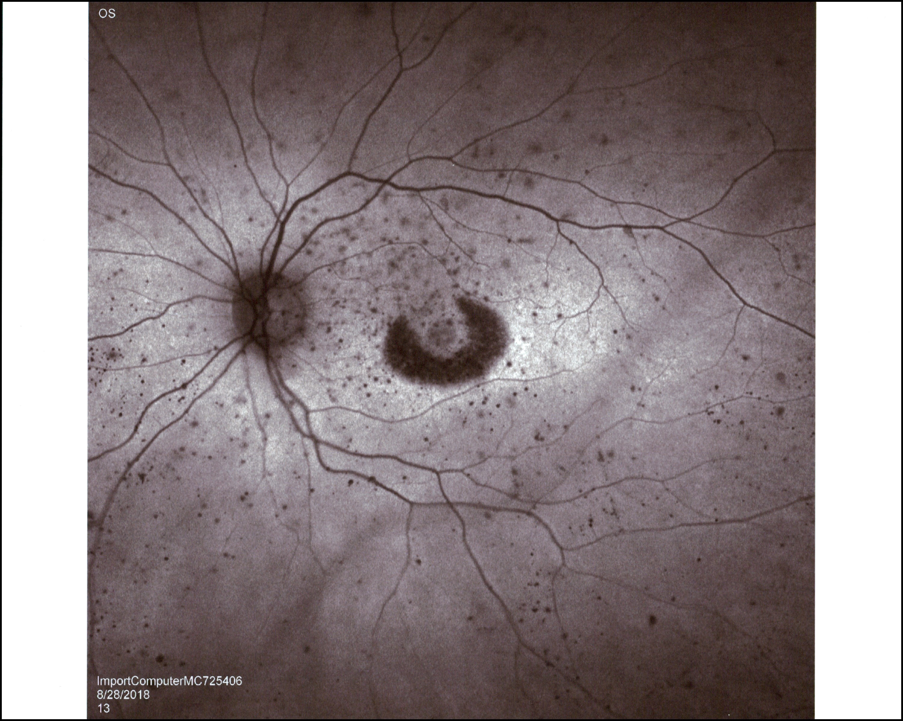 Plaquenil Toxicity Ascrs