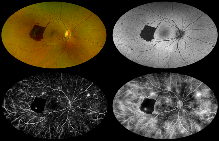 Operculated Retinal Hole In Retinal Detachment Retina